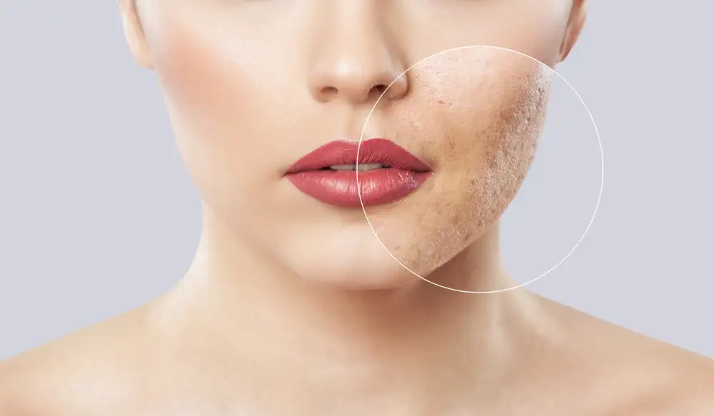 laser acne scar treatment in saudi arabia
