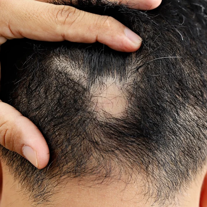alopecia areata treatment in saudi arabia