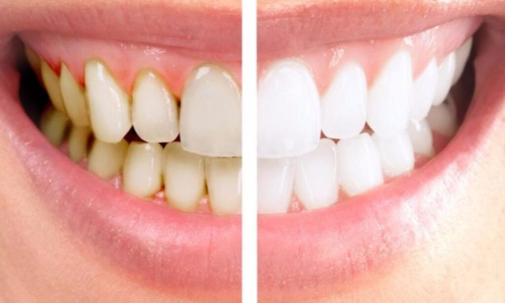 teeth scaling before and after