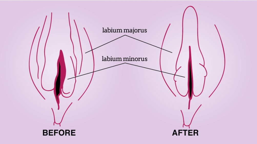 Fillers for Vaginal Enhancement before and after 11111