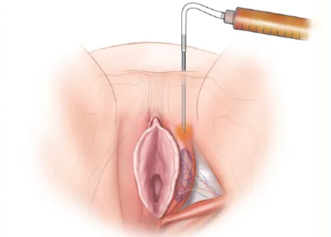 Fillers for Vaginal Enhancement procedure