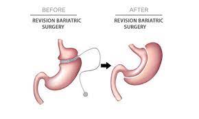 REVISION BARIATRIC SURGERY before and after