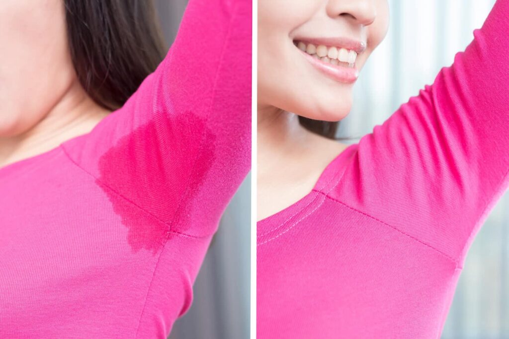 hyperhidrosis treatment before and after