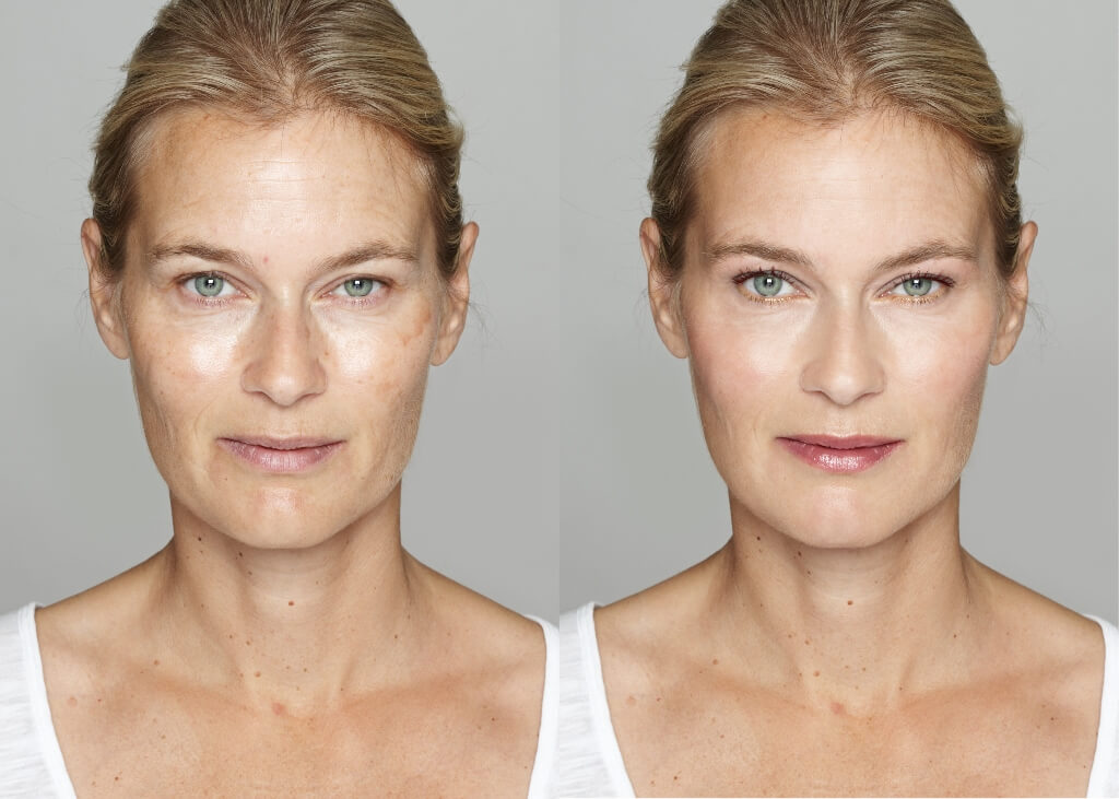 spectra laser carbon peel before and after