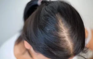 7 Interesting Facts about Alopecia Areata Treatment In Riyadh