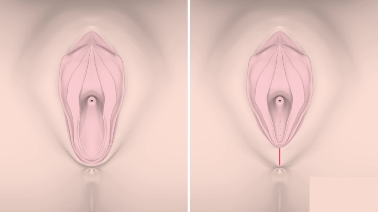 Postpartum vaginal rejuvenation before and after