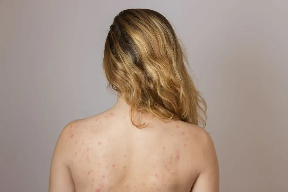 how to treat back acne and its effects in riyadh