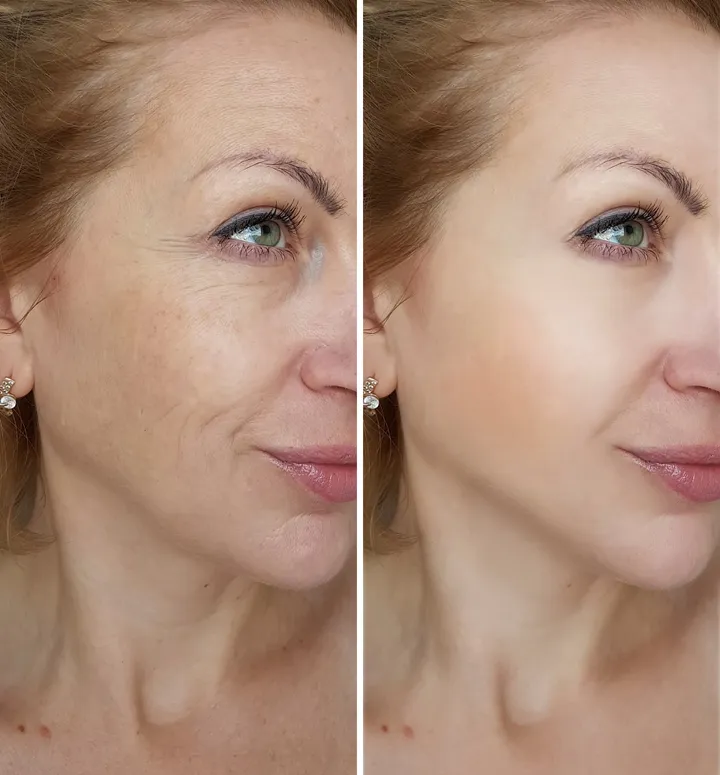 skin rejuvenation before and after