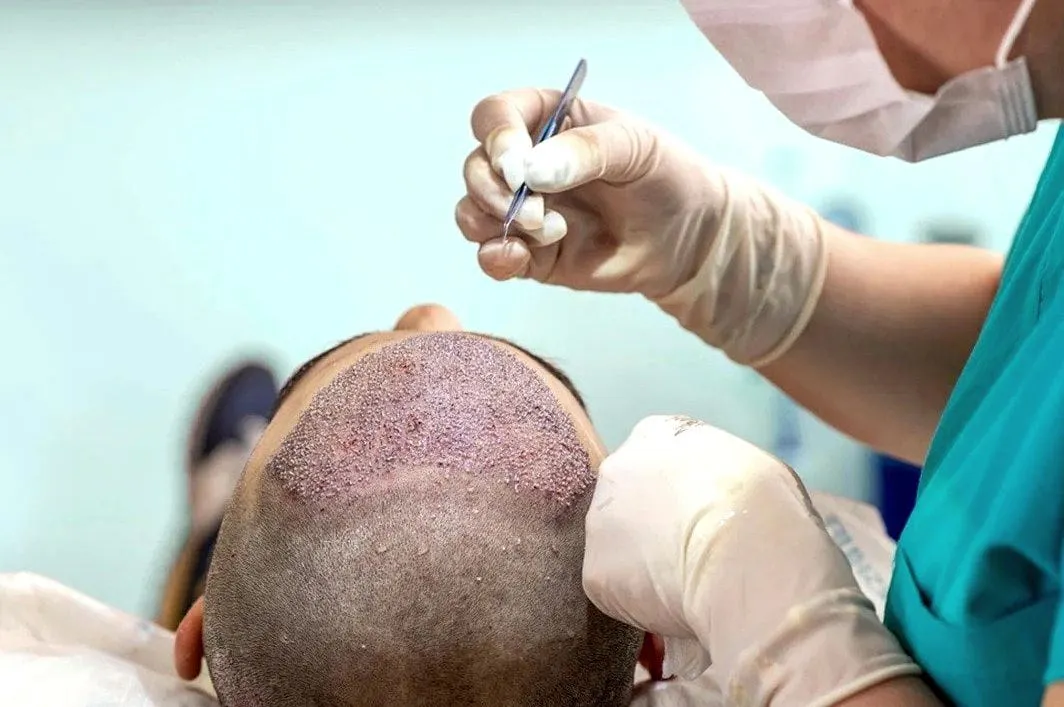 Celebrity Hair Transplant in Riyadh