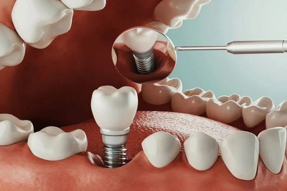 Dental Implants Cost in Saudi Arabia