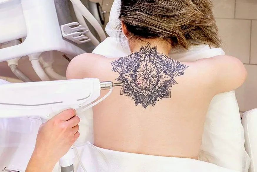 Laser Tattoo Removal Cost in Riyadh