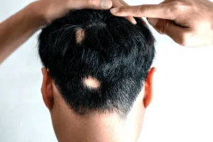 Alopecia Areata Treatment Cost in Riyadh, Saudi Arabia