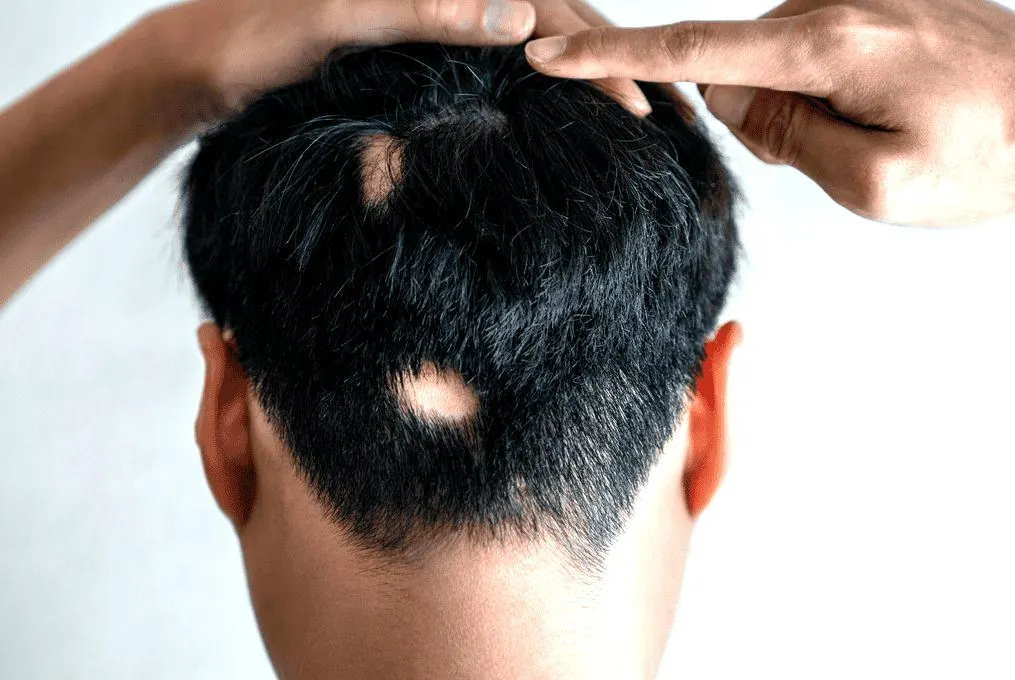 Alopecia Areata Treatment Cost in Riyadh, Saudi Arabia