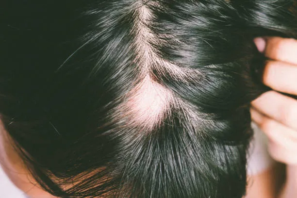alopecia areata cost in riyadh