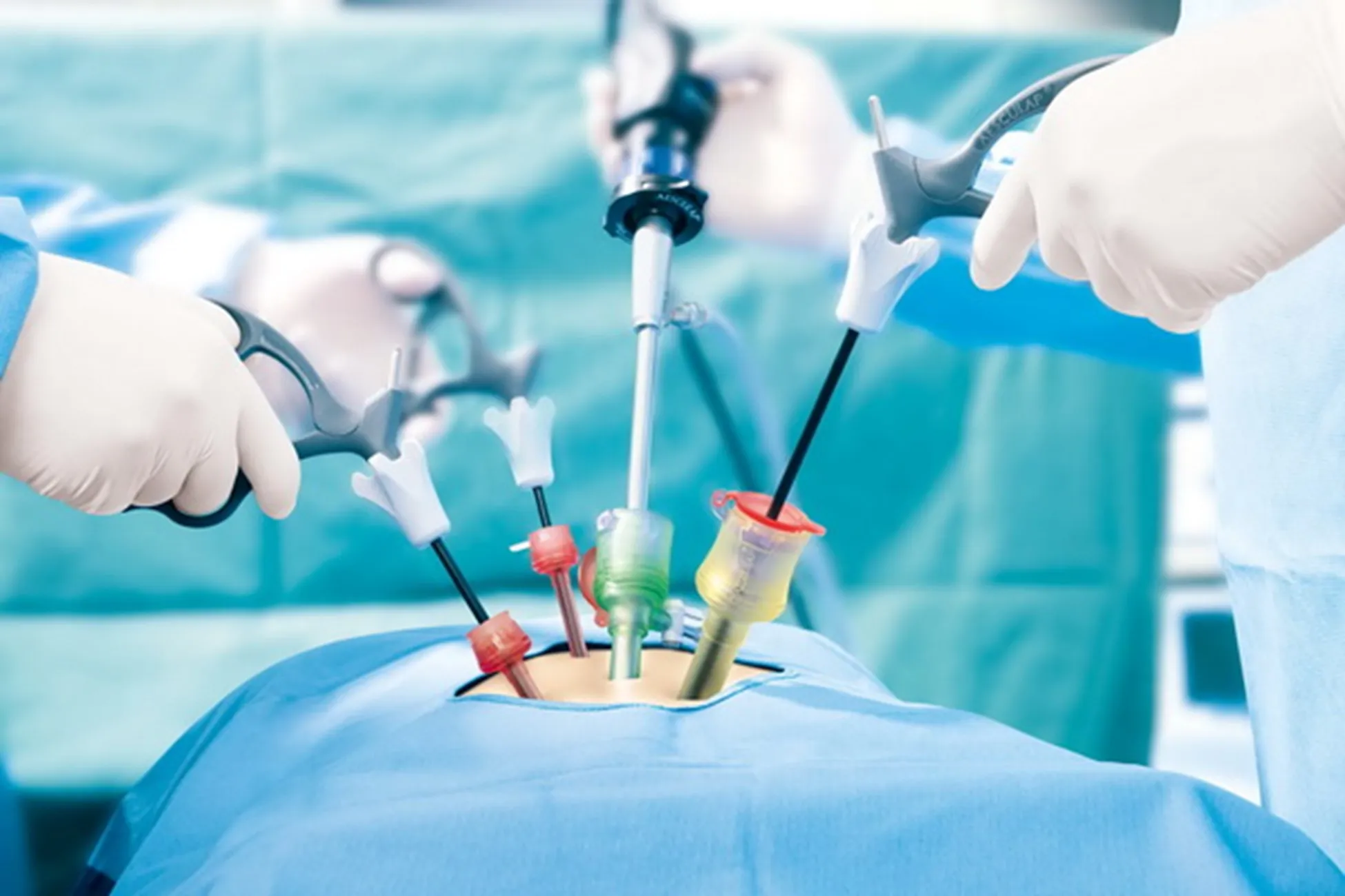 laparoscopic surgery cost in riyadh