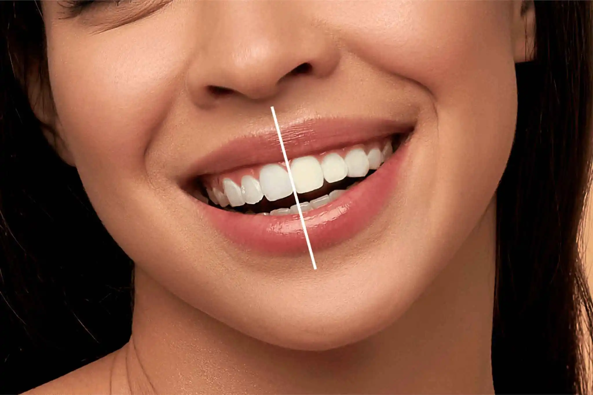 Does Teeth Whitening Work Permanently in Riyadh