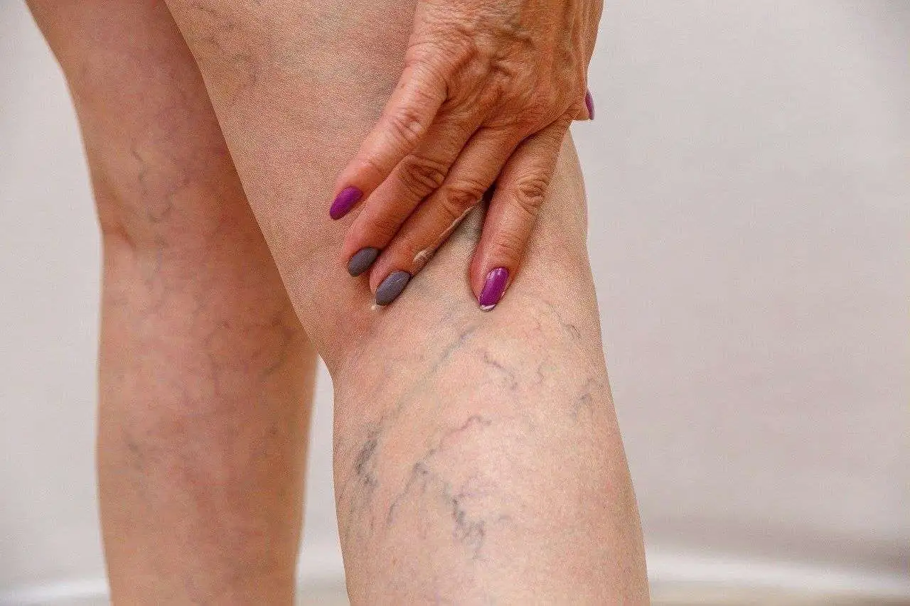 Varicose Veins Treatment Price in Riyadh