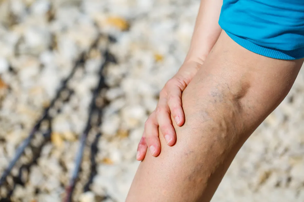 What is the Most Effective Treatment for Varicose Veins Treatment