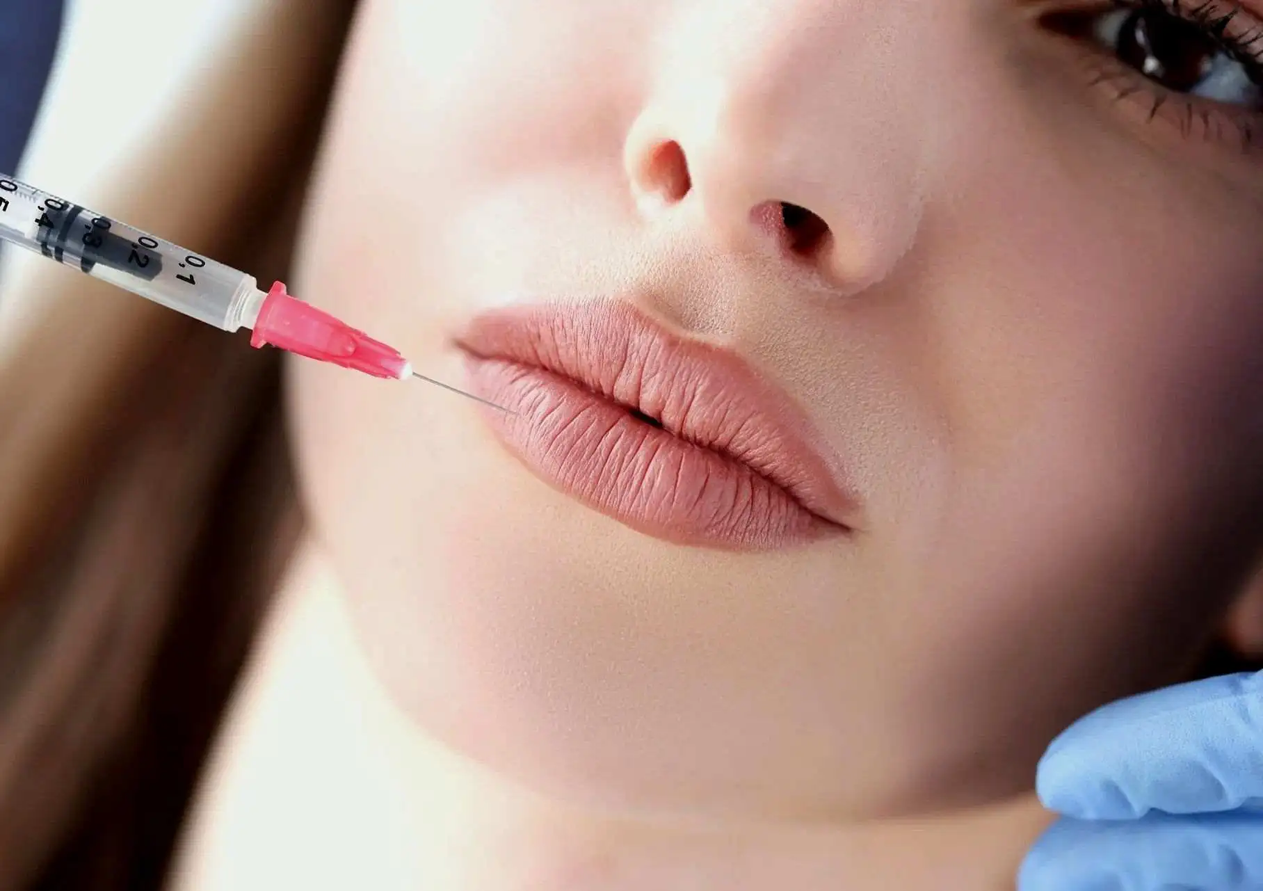 What to Expect after having Lip Filler.