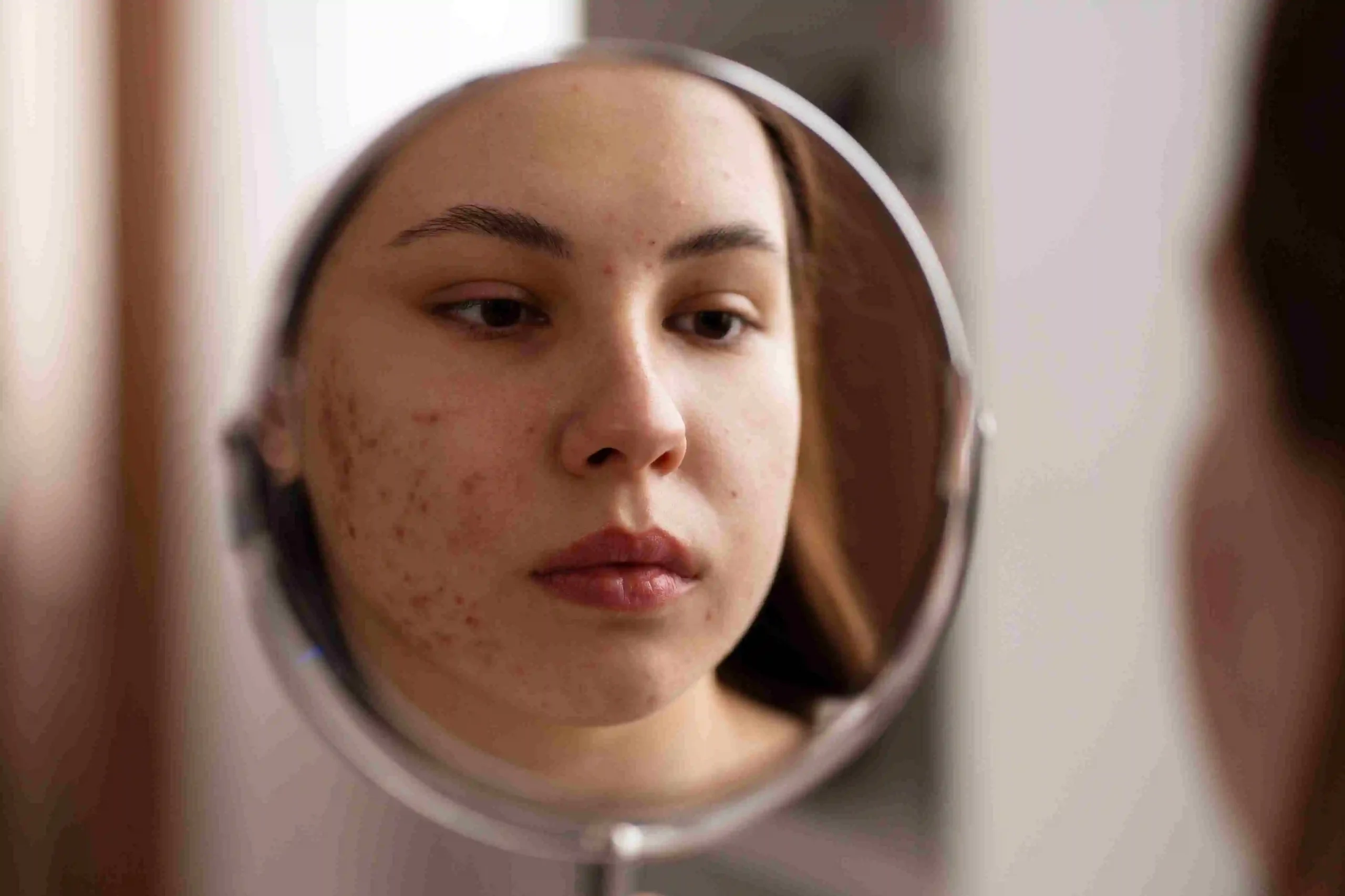 lASER ACNE SCAR TREATRMENT Cost