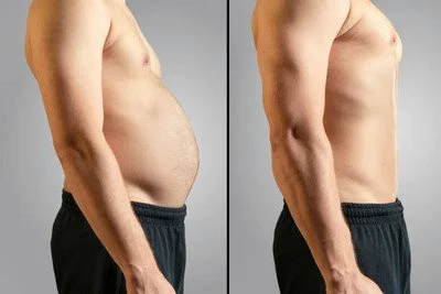 Vaser 4D Liposuction before and after in Riyadh,3