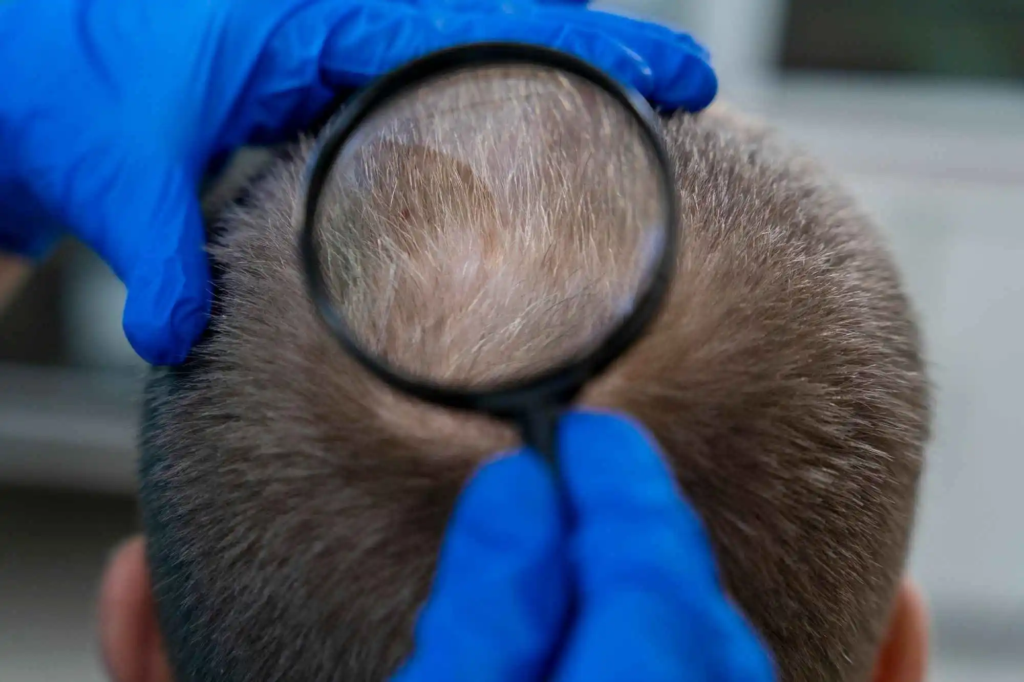 Causes and Treatment of Alopecia Areata Treatment