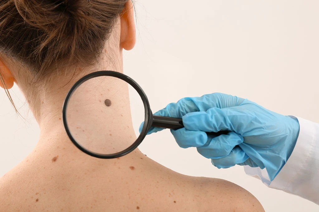 Which Method Is Best For Mole Removal