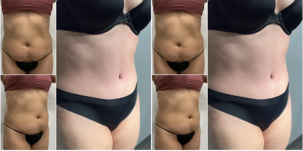 Circumferential Abdominoplasty Before & After Result in Riyadh Enfield Royal Clinic Saudia