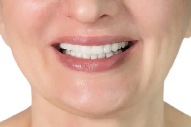 Clean Teeth before and after results in riyadh EnfieldRoyalRiyadh