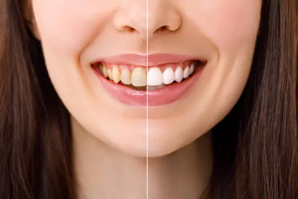 Clean Teeth in riyadh before and after results