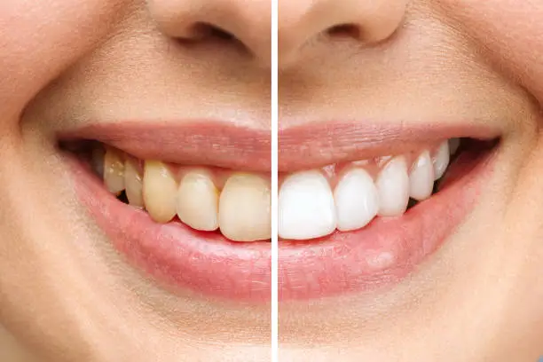 Clean Teeth results before and after in riyadh