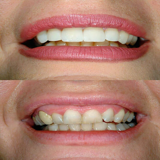 Clean Teeth results in riyadh before and after