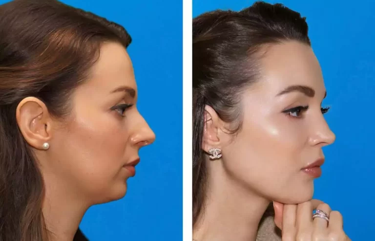 Double Chin Removal before after in Riyadh