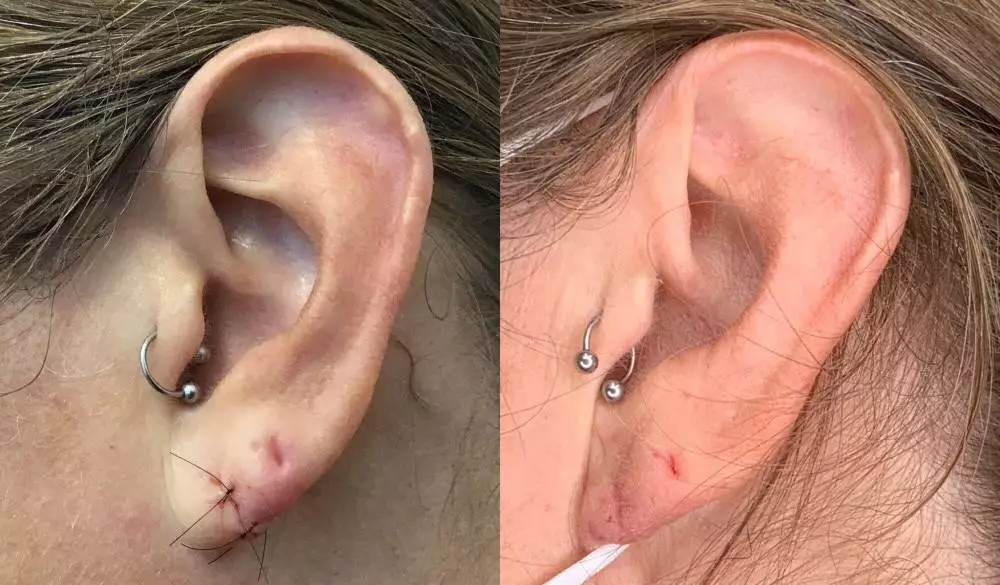 Earlobe Correction Surgery before after results in Riyadh