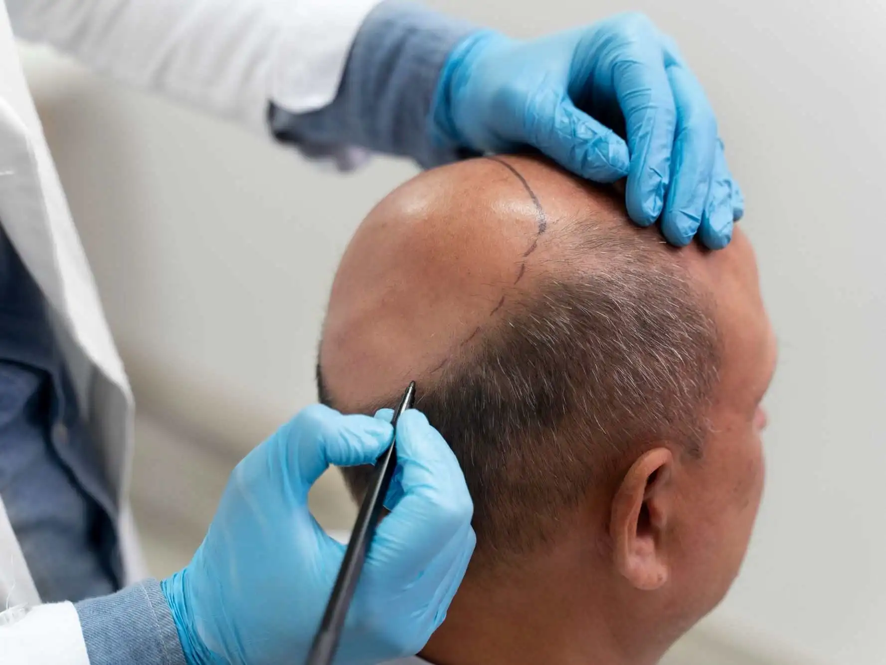 FUE Hair Transplant Cost in Riyadh