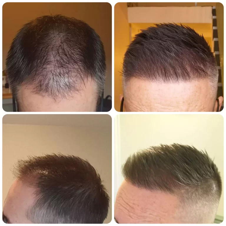 Follicular Unit Extraction (FUE) Hair Transplant before and after result in riyadh