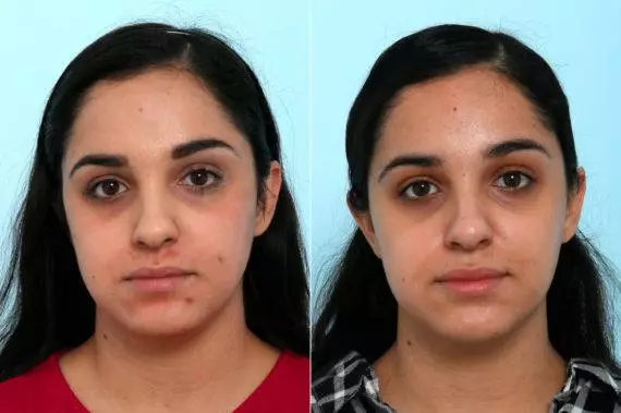 Fractional Laser Treatment before after results in Riyadh