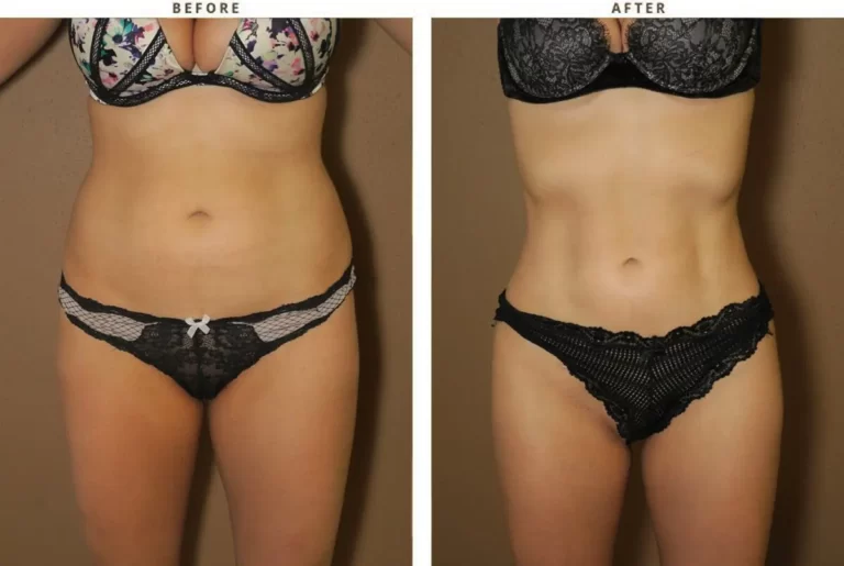 GPS Laser Liposuction before after results in Riyadh