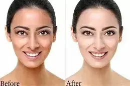 Glutathione Injection before after results in Riyadh