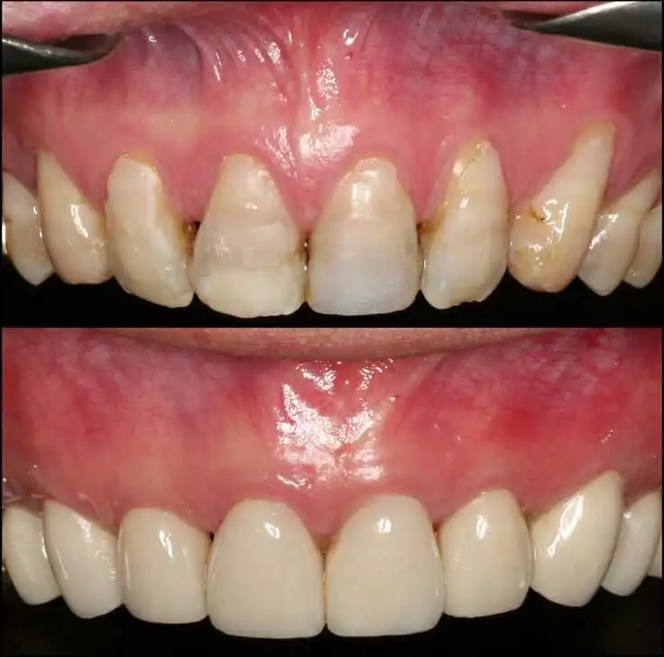Gum Recession Treatment before after results in Riyadh