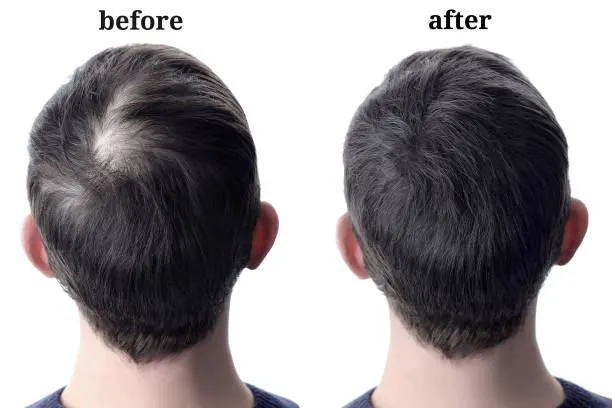 Hair Loss Treatment befdore after results in Riyadh