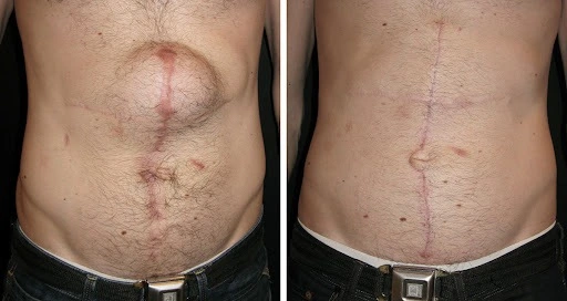 Hernia surgery before and after results in riyadh