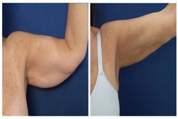 J Plasma for Thighs and Arms brfore and after