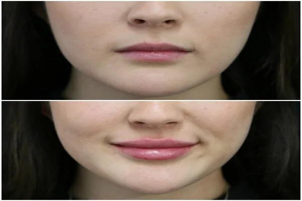 Lip Augmentation before & after in Riyadh