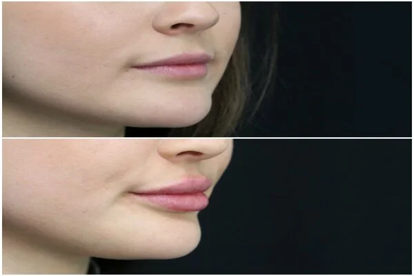 Lip Augmentation before & after results in riyadh