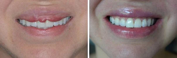 Lip Reduction Before & After Result in Riyadh Enfield Royal Clinic