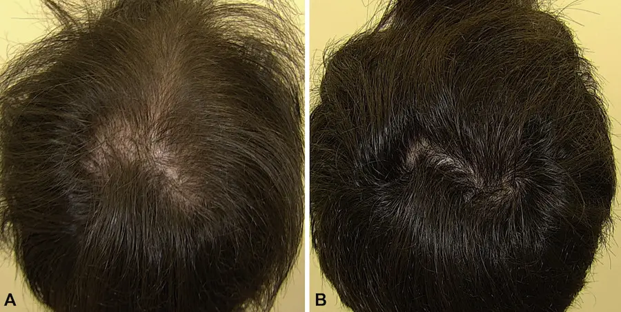 Male Baldness Treatment Before & After Result in Riyadh Enfield Royal Clinic Saudi