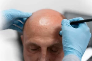 Male Hair Transplant Cost in Riyadh