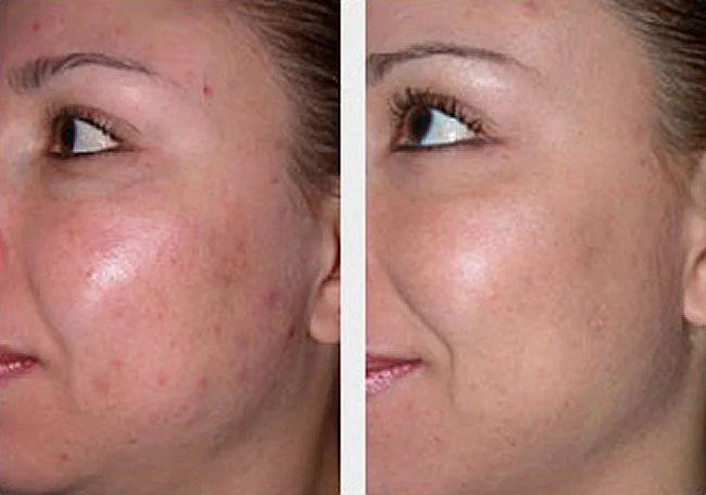 Microdermabrasion in Riyadh Before And After Result Enfield Royal Clinic Saudi