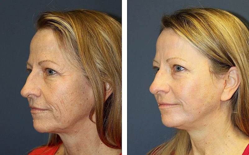 Non Surgical Facelift Before & After result in Riyadh Enfield Royal Saudi